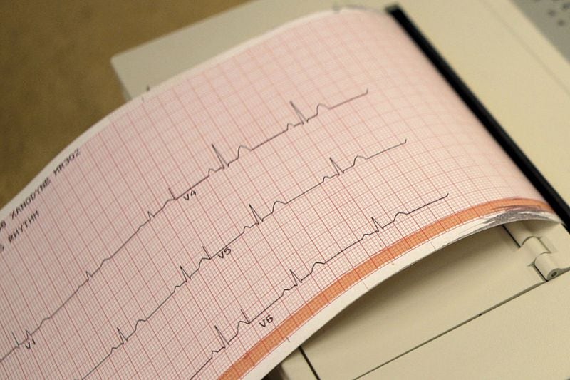 A printout from an electrocardiogram machine, which measures heart activity. (AP Photo/Jeff Roberson)