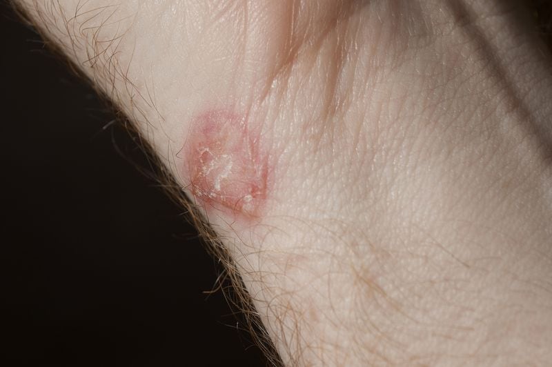 A rare fungus recently caused the first-ever U.S. case of sexually transmitted ringworm. Reported in JAMA Dermatology on Wednesday, a new study helmed by doctors from NYU Langone Health revealed the case involved a New York City man in his 30s. (Dreamstime/TNS)
