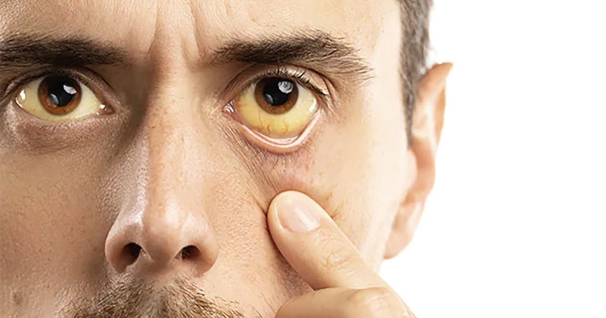 Bachelor Joey Graziadei reveals cause of yellow eyes