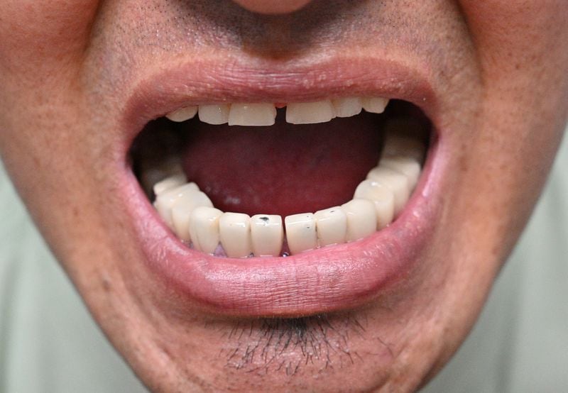 June 24, 2022 Clarkston - Ahmad Farid Frotan shows his teeth as he explains the need of dental care for him and his wife at Ethne Health Clinic in Clarkston on Friday, June 24, 2022. The medical practitioners at Ethne Health, a Clarkston community clinic, say many of their patients suffer from oral health problems. They hope to one day be able to expand and start operating a dental center in the community. (Hyosub Shin / Hyosub.Shin@ajc.com)