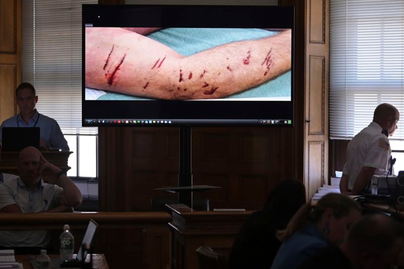 EDS NOTE: GRAPHIC CONTENT - An autopsy photo showing injuries to John O'Keefe's arm is displayed during Karen Read's trial in Norfolk Superior Court, Friday, June 21, 2024, in Dedham, Mass. Read, 44, is accused of running into her Boston police officer boyfriend with her SUV in the middle of a nor'easter and leaving him for dead after a night of heavy drinking. (AP Photo/Josh Reynolds, Pool)