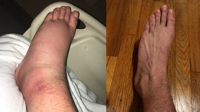 Paul Sweatman’s foot swelled up with a mystery bacterial infection in the fall of 2017, and an urgent care clinic told him to get to the emergency room. The hospital treated him for three days and the foot did not have to be amputated. But days later the swelling returned, and he rushed back to the ER. Anthem/Blue Cross said the second visit was not an emergency and refused to pay.  Under a new law going into effect Jan. 1, 2022 to stop surprise billing, insurance companies have looser rules around paying for non-emergency surprise services than they do for emergencies. These photos show Sweatman's foot during Sweatman’s first trip to the hospital, and as it usually is. (Photos courtesy of Paul Sweatman)