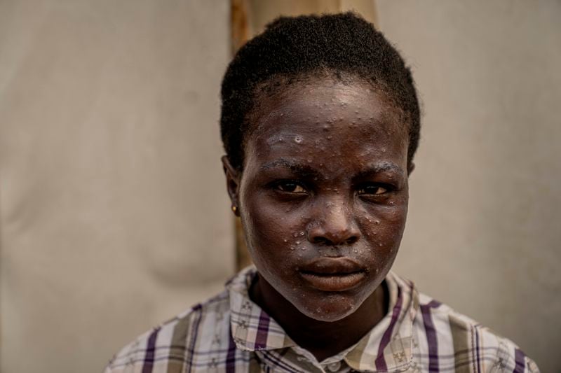 A young girl suffering from a mpox waits for treatment at a clinic in Munigi, eastern Congo, Monday, Aug. 19, 2024. Congo will receive the first vaccine doses to address its mpox outbreak next week from the United States, the country's health minister said Monday, days after the World Health Organization declared mpox outbreaks in Africa a global emergency. (AP Photo/Moses Sawasawa)