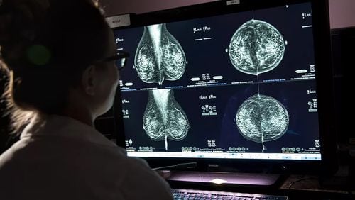 A recommendation from the U.S. Preventive Services Task Force says breast cancer screening should start at age 40 to benefit groups including Black women and women with dense breasts. (Jay L. Clendenin/Los Angeles Times/TNS)