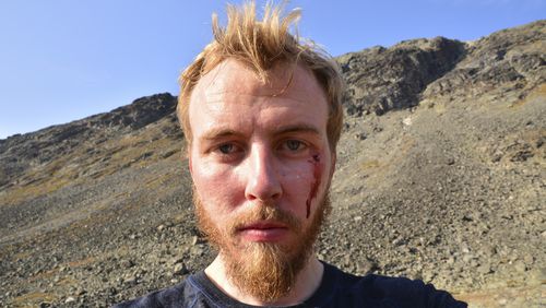 Photo taken on Thursday, Sept. 5, 2024 of Francis Ari Sture with signs of an attack of the golden eagle that also attacked a toddler in Norway in what an ornithologist says is likely the bird’s in the fourth such attack on humans in the past week. The bird’s unusual aggression occurred over five days across a vast mountainous area of southern Norway. (Francis Ari Sture/NTB Scanpix via AP)