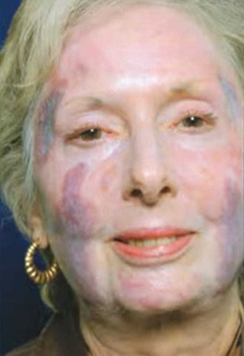 Marietta real estate agent Betty Nestlehutt was left with large permanent scars after undergoing surgery by Atlanta plastic surgeon Harvey "Chip" Cole in 2006. She won $1.2 million at trial against Cole. Images of Nestlehutt's injuries are part of the public record in her medical malpractice case. Courtesy