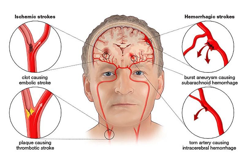 There are two types of stroke: Ischemic and hemorrhagic. Ischemic strokes are the most common, occurring when a blood vessel becomes blocked, usually by a blood clot, and a portion of the brain is deprived of oxygen. The fatality rate is higher for a hemorrhagic stroke, which can occur when an aneurysm, a blood-filled pouch that balloons out from an artery, ruptures, flooding the surrounding tissue with blood. See below for recommendations on stroke prevention from the Stroke Awareness Foundation. (Courtesy of the Stroke Awareness Foundation)