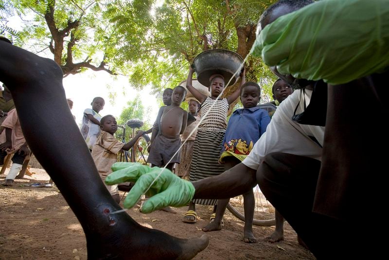 A medical worker extracts a Guinea worm from a child’s leg in northern Ghana in 2007. (Wes Pope/Chicago Tribune/TNS)