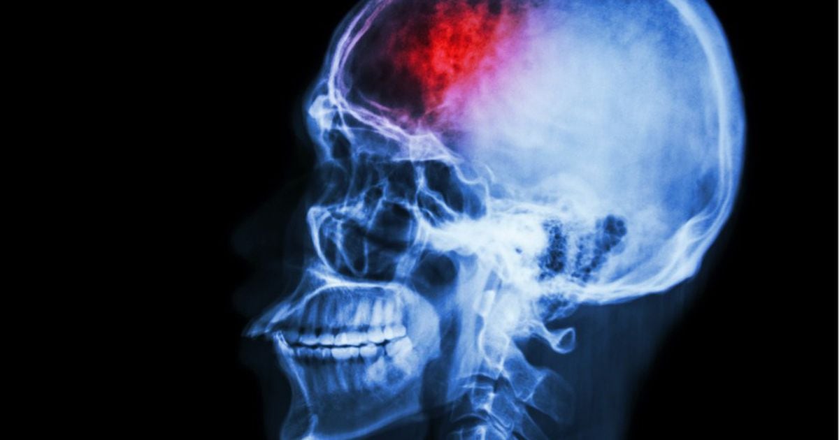 41% of Young Athletes Show Signs of CTE - Neuroscience News