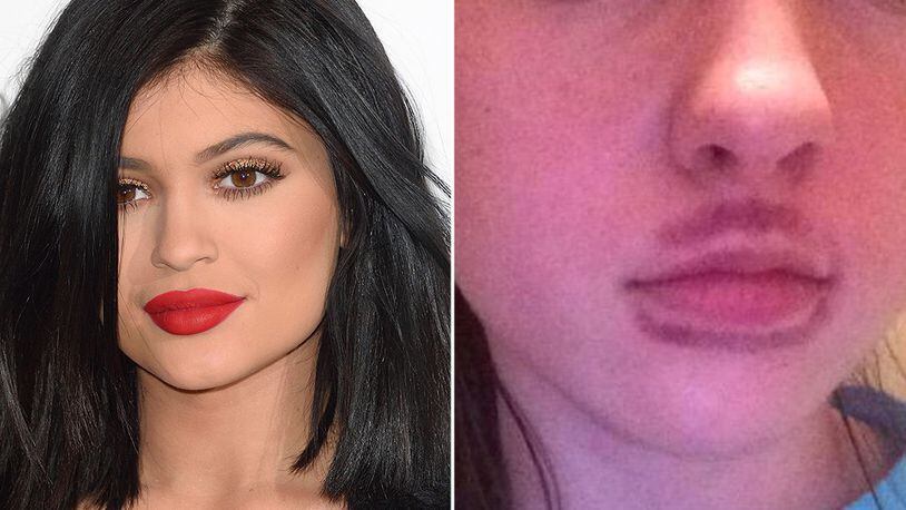 Bruised Lips From Kylie Jenner Challenge