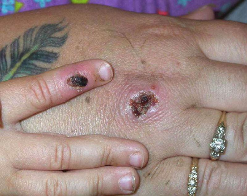 In this Centers for Disease Control and Prevention handout graphic, symptoms of one of the first known cases of the monkeypox virus are shown on a patient's hand on June 5, 2003. (CDC/Getty Images/TNS)