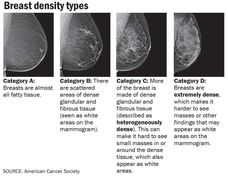 A brand new rule may just lend a hand ladies spot most cancers previous