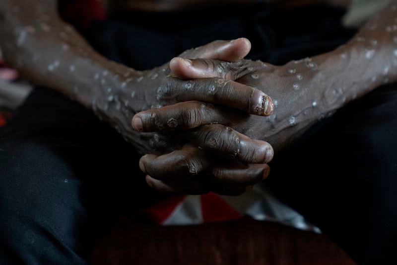 A man suffering from mpox waits for treatment at the Kamituga General Hospital in South Kivu Congo, Wednesday, Sept. 4, 2024. (AP Photo/Moses Sawasawa)