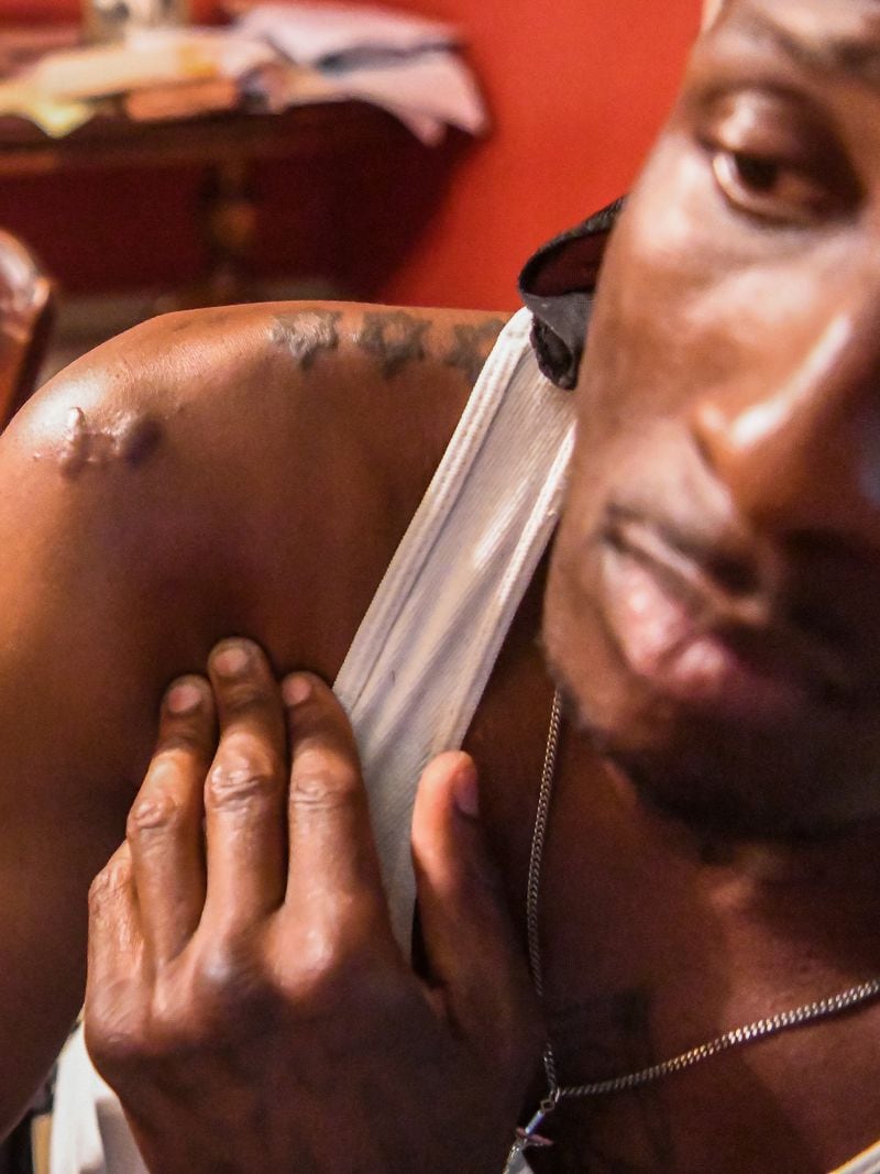 Terry Anthony shows some of the scars from his stab wounds during an interview in Luthersville.  (Ziyu Julian Zhu / AJC)