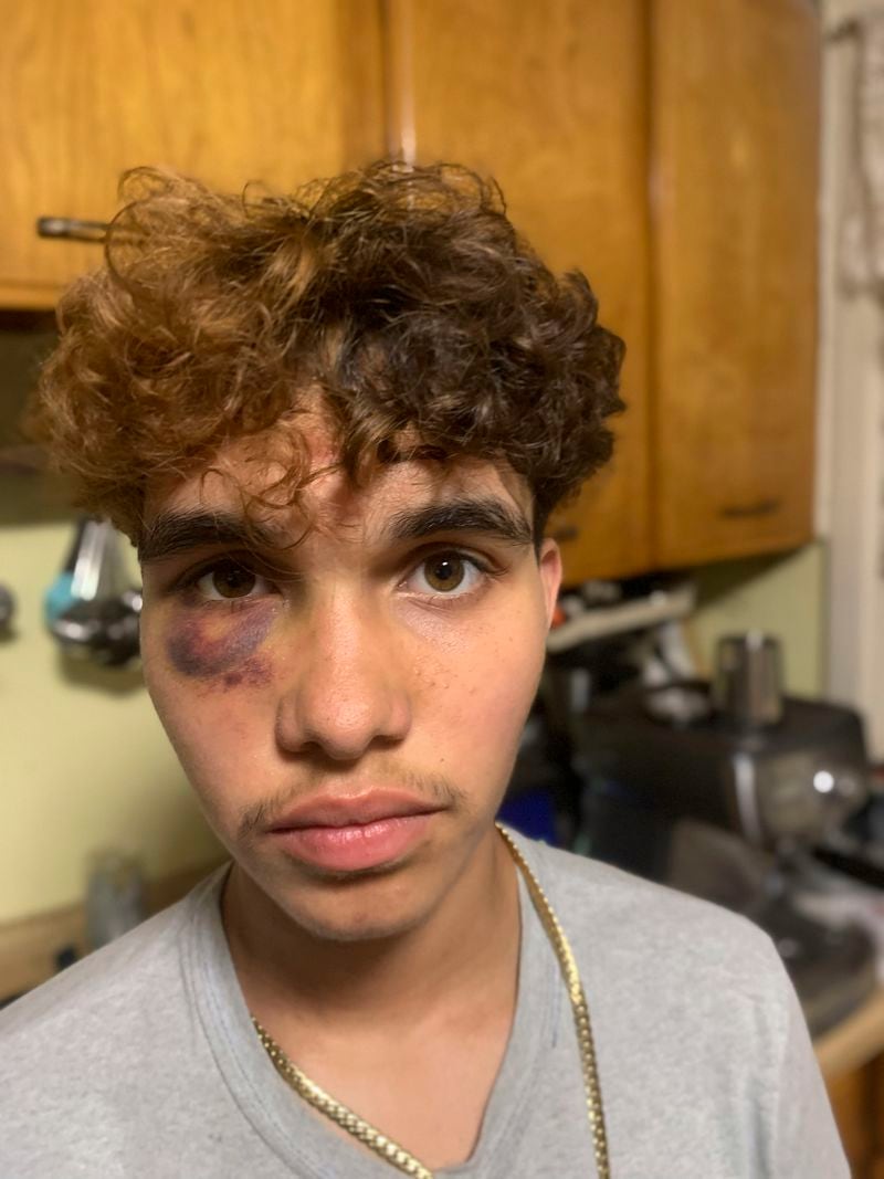 In an unknown location, a photo taken Monday, Sept. 2, 2024, a transgender high schooler from Massachusetts, Jayden Tkaczyk, shows the injuries he suffered after being allegedly beaten up at a party. (Steven Tkaczyk via AP)