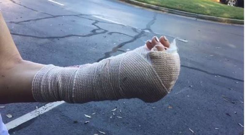 A woman is now in a cast after an attack near Sandy Springs office building. (Credit: Channel 2 Action News)