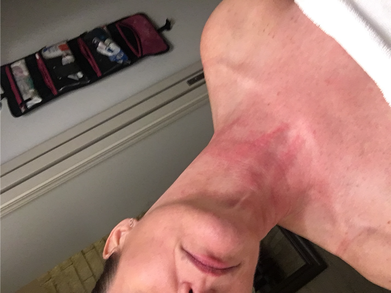 A photo of Gwyneth Gilbert's rash from the lawsuit filing.