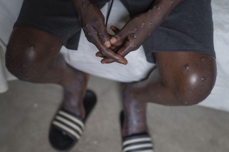 FILE - An unidentified man infected with mpox at the Goma General Hospital, Democratic Republic of the Congo, on July 16, 2024 where he continues treatment. The World Health Organization declared the mpox outbreaks in Congo and elsewhere in Africa a global emergency on Wednesday, aug. 14, 2024, with cases confirmed among children and adults in more than a dozen countries and a new form of the virus spreading. Few vaccine doses are available on the continent. (AP Photo/Moses Sawasawa)