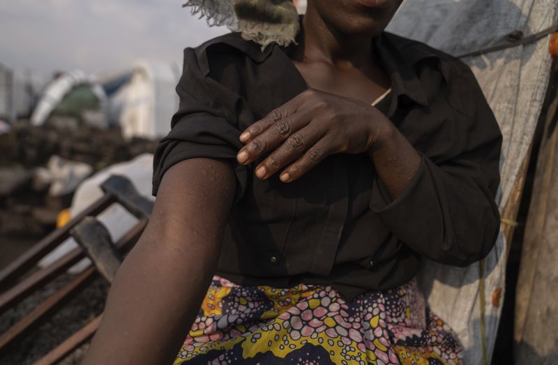 Sarah Bagheni, in the Bulengo refugee camp in Goma, Congo, suspects she may be infected with Mpox after the World Health Organization had declared Thursday, Aug, 15, 2024, the increasing spread of mpox in Africa a global health emergency, warning the virus might ultimately spill across international borders. (AP Photo/Moses Sawasawa)