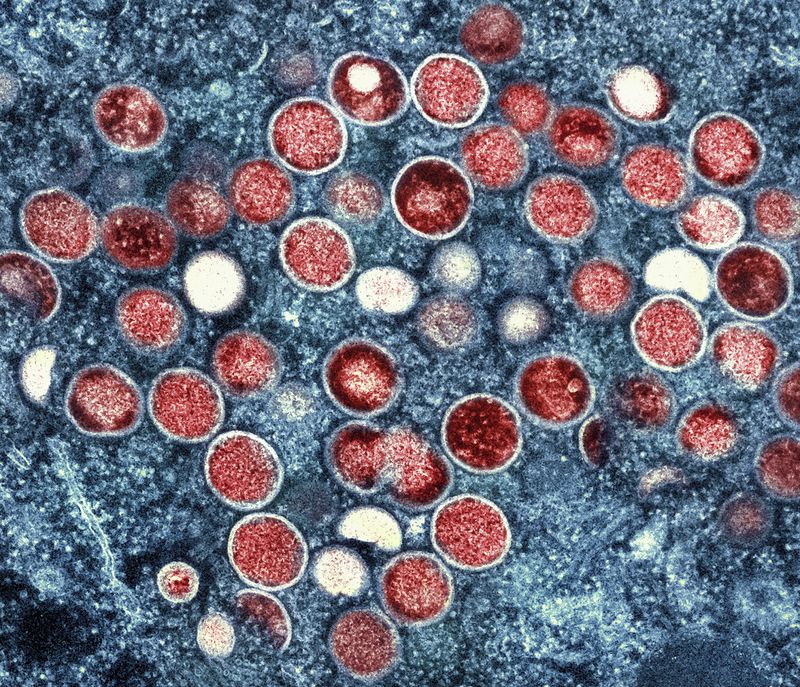 FILE - This undated image provided by the National Institute of Allergy and Infectious Diseases shows a colorized transmission electron micrograph of monkeypox particles (red) found within an infected cell (blue), cultured in the laboratory that was captured and color-enhanced at the NIAID Integrated Research Facility in Fort Detrick, Md. (NIAID via AP, File)