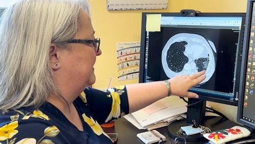 FILE - Dr. Lee Morissette shows an image of lungs damaged by asbestos exposure, April 4, 2024, at the Center for Asbestos Related Disease in Libby, Mont. (AP Photo/Matthew Brown, File)