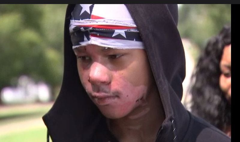 Malachi McFadden was badly burned during an experiment in his high school chemistry class.