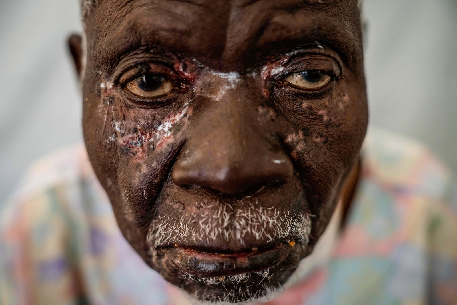 FILE - Christophe Chavilinga, 90, waits for treatment for mpox at a clinic in Munigi in eastern Congo, Aug. 16, 2024. (AP Photo/Moses Sawasawa, file)