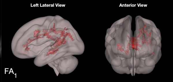 Brain scans show how reading positively affects children's brains. Image courtesy of Dr. John S. Hutton of Cincinnati Children’s Hospital