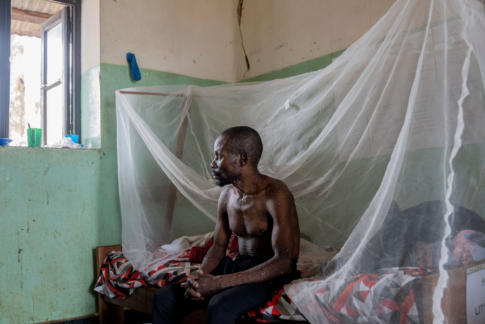 FILE - A man suffering from mpox poses for a photograph as he waits for treatment at the Kamituga General Hospital in South Kivu Congo, Sept. 4, 2024. (AP Photo/Moses Sawasawa, file )