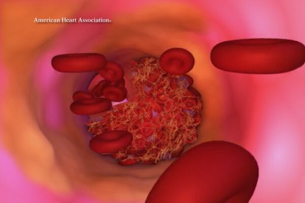 PAD is primarily caused by the buildup of fatty plaque in the arteries, which is called atherosclerosis. Graphic Provided by The American Heart Association, metro Atlanta chapter