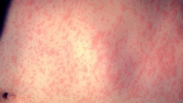 There has been a confirmed case of measles in Atlanta and three cases in Cobb County.