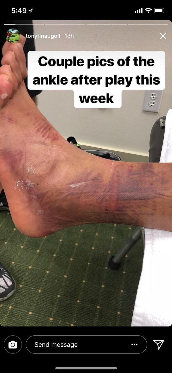 Tony Finau shares photos of his injured ankle after 2018 Masters Tournament.