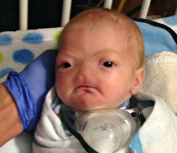 Baby Eli Thompson was born on March 4, 2015 with a rare medical condition that left him without a nose. His father described him as a happy child who inspired others. Eli died on Saturday at a medical center in Mobile, Alabama.