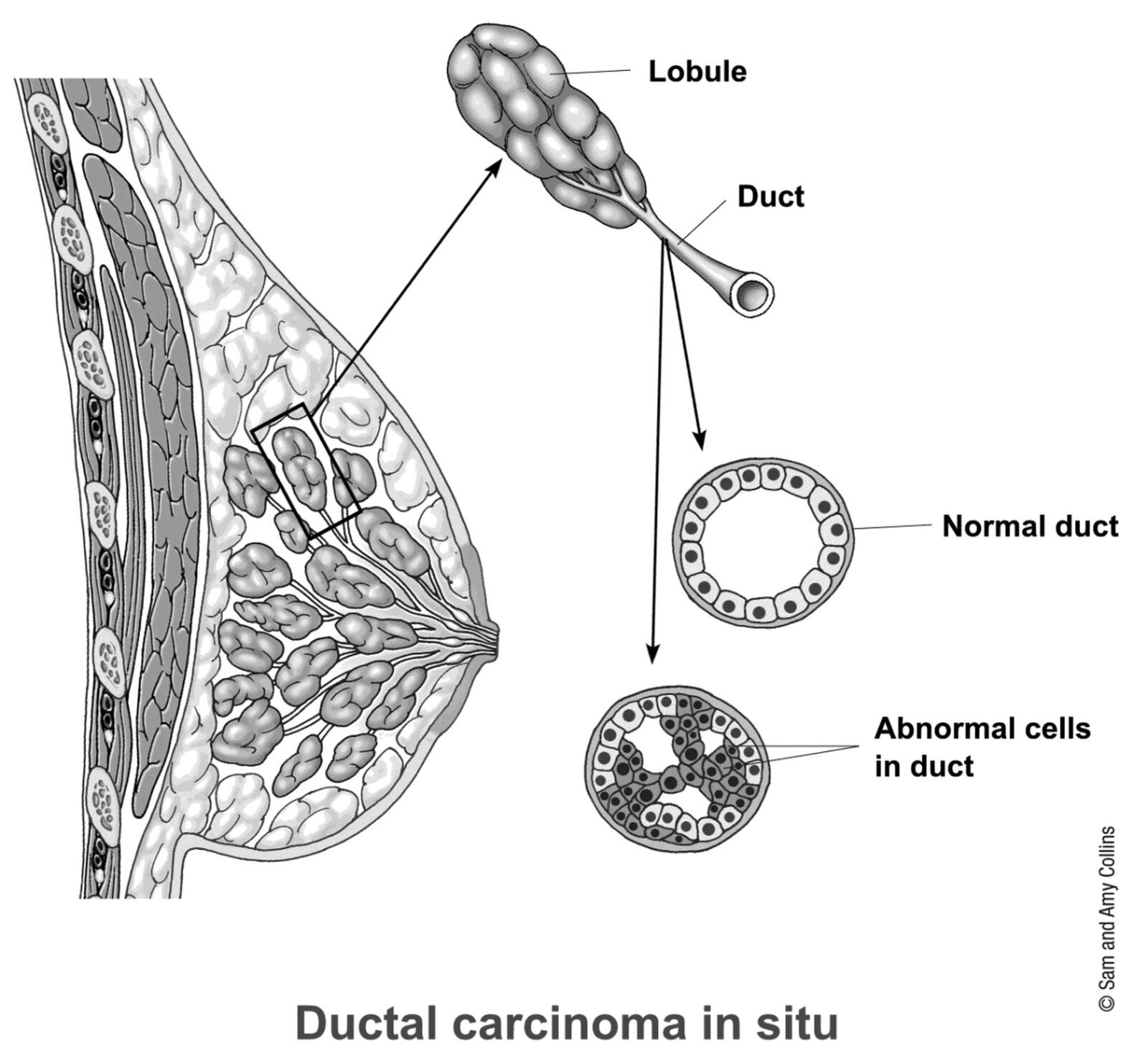 Ductal carcinoma in situ (DCIS) is also called intraductal carcinoma and stage zero breast cancer. DCIS is a noninvasive or pre-invasive breast cancer. This means the cells that line the ducts have changed to cancer cells but they have not spread through the walls of the ducts into the nearby breast tissue. 