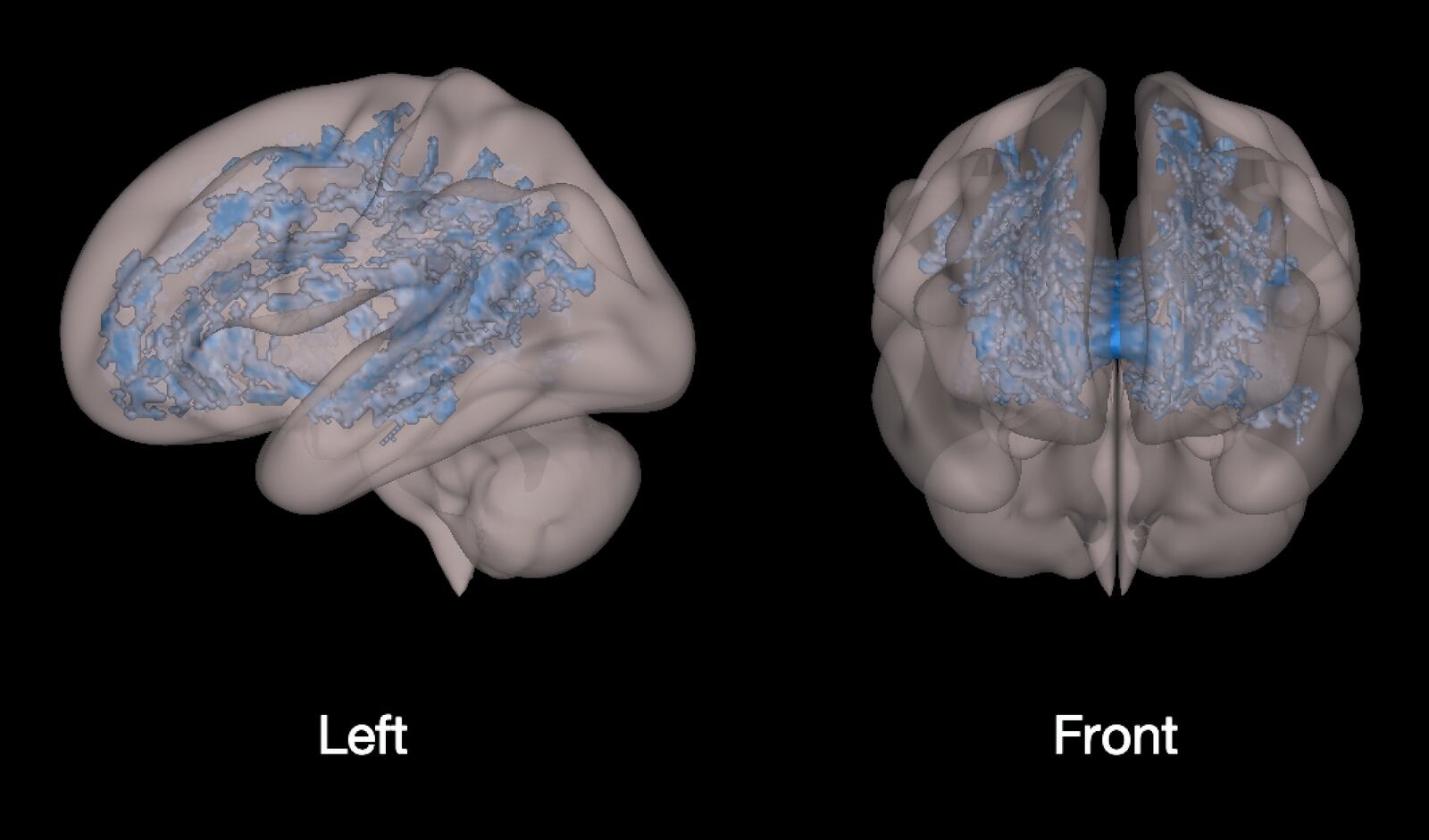 Brain scan shows how screen time negatively affects children's brains. Image courtesy of  Dr. John S. Hutton of Cincinnati Children’s Hospital.