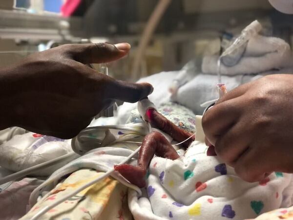 Baby Jayla was born 18 weeks early at Northeast Georgia Medical Center on March 17, 2022. She weighed only 14.6 ounces and stretched only 10.63 inches, small enough to almost fit in the palm of a hand. This photo was taken shortly after she was born, and shows her parents' hands close by. (Contributed by Audreona Scott)