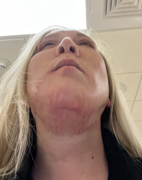 Jennifer Messer claims that Atlanta cosmetic surgeon Harvey "Chip" Cole left her permanently scarred and deformed. She is one of several of Cole's patients suing him for malpractice.