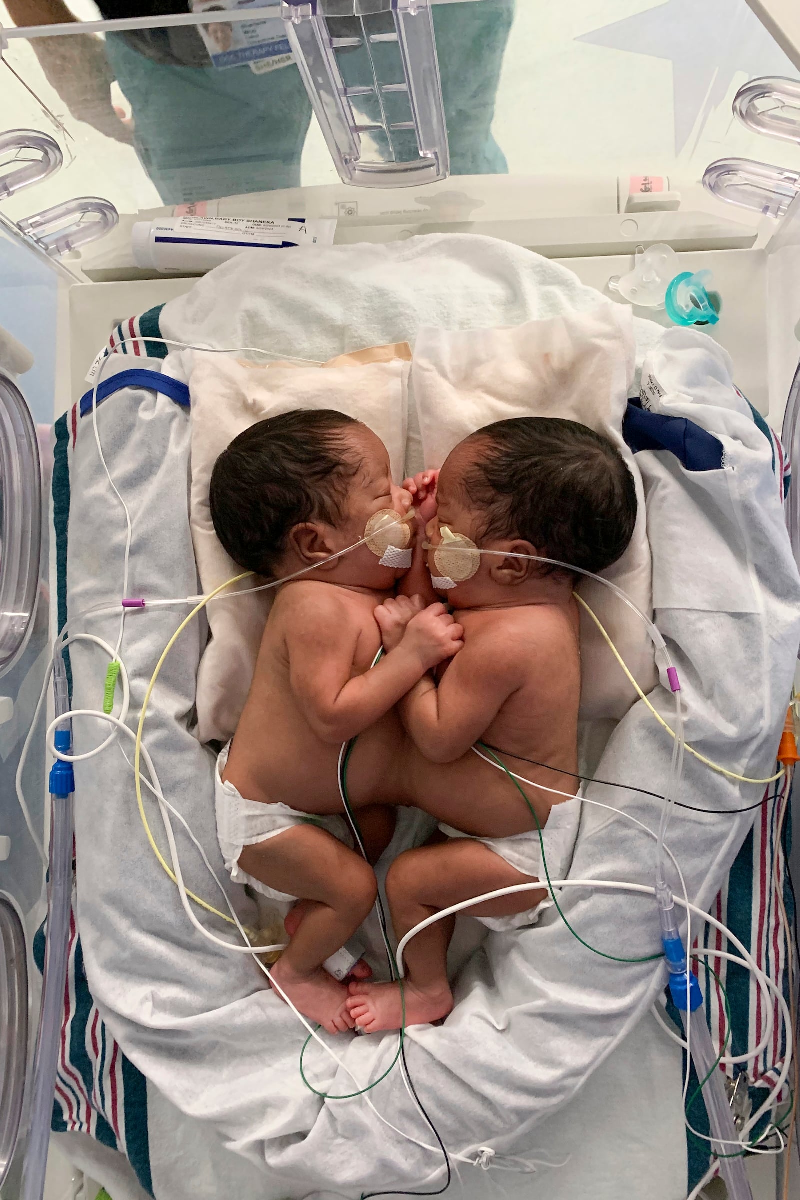 This undated photo provided by the Children’s Hospital of Philadelphia in October 2024 shows conjoined twins, Amari and Javar Ruffin, at the Children’s Hospital of Philadelphia. (Children’s Hospital of Philadelphia via AP)