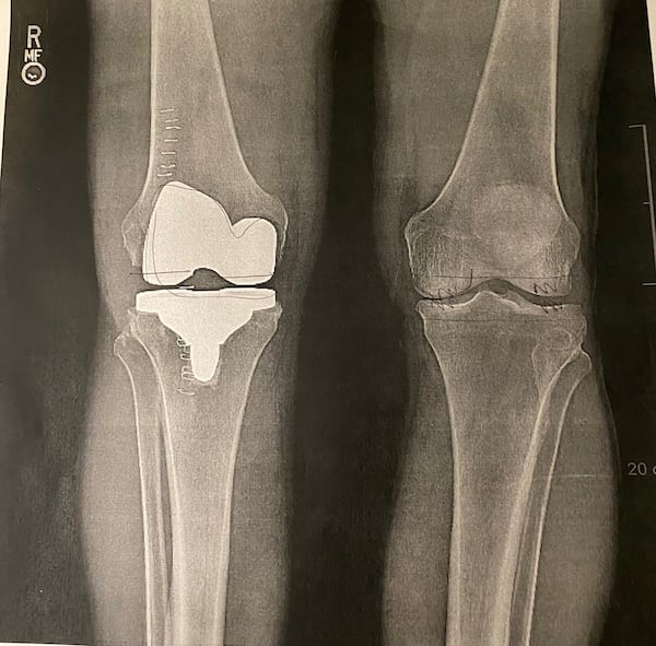 The inside look at my new knee. Staples still intact.