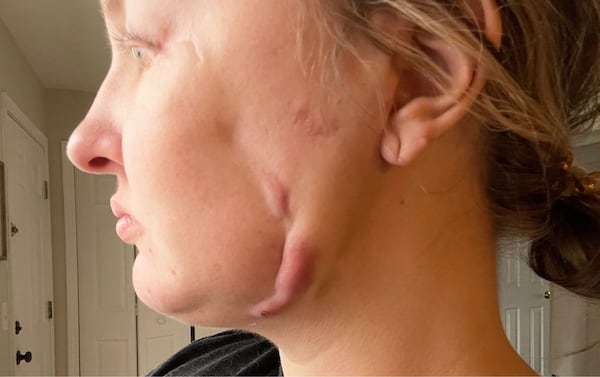 Kayla Cannon is suing Atlanta cosmetic surgeon Harvey "Chip" Cole, claiming he left her permanently disfigured. She gave permission for photographs of her face to be published. Courtesy