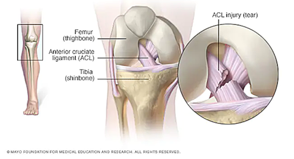 The Anterior Cruciate Ligament — one of two ligaments that crosses the middle of the knee — connects your thighbone (femur) to your shinbone (tibia) and helps stabilize your knee joint. According to the Mayo Clinic, most ACL injuries happen during sports and fitness activities that can put stress on the knee, including: suddenly slowing down and changing direction (cutting), pivoting with your foot firmly planted, landing from a jump incorrectly, stopping suddenly, and receiving a direct blow to the knee. The MCL, or the Medial Collateral Ligament is the wide, thick band of tissue that runs down the inner part of the knee from the thighbone (femur) to a point on the shinbone (tibia), which is behind the ACL and about 4 to 6 inches from the knee.