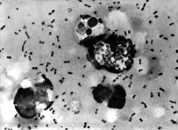 A bubonic plague smear, prepared from a lymph removed from an adenopathic lymph node, or bubo, of a plague patient, demonstrates the presence of the Yersinia pestis bacteria that causes the plague in this undated photo.