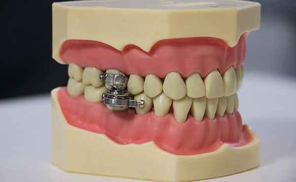 DentalSlim Diet Control is fitted by a dental professional to the upper and lower back teeth. Photo courtesy of University of Otago