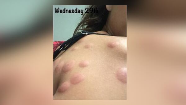 Sabrina Jales St. Pierre is suing a California hotel after she said she suffered from extreme bedbugs while staying there.