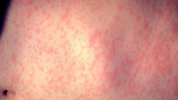 <p>Measles case confirmed in metro Atlanta, officials say</p>