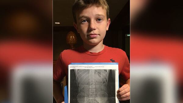 Conner Parker poses with the X-ray showing the Buckyball in his intestine.