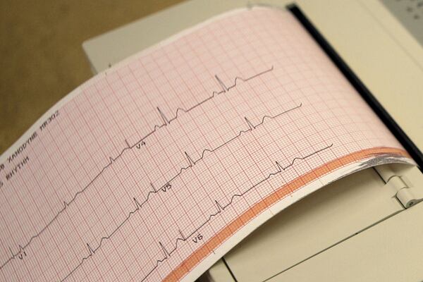 A printout from an electrocardiogram machine, which measures heart activity. (AP Photo/Jeff Roberson)