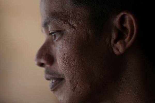 Suardi, a crocodile attack survivor, shows the scars on his face in Budong-Budong, West Sulawesi, Indonesia, Monday, Feb. 24, 2025. (AP Photo/Dita Alangkara)