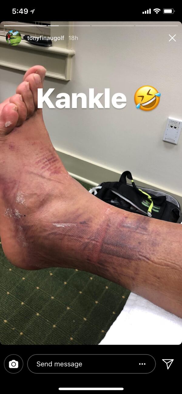 Tony Finau shares photos of his injured ankle after 2018 Masters Tournament.