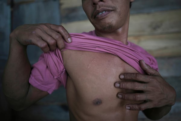 Suardi, a crocodile attack survivor, shows a scar on his chest in Budong-Budong, West Sulawesi, Indonesia, Monday, Feb. 24, 2025. (AP Photo/Dita Alangkara)